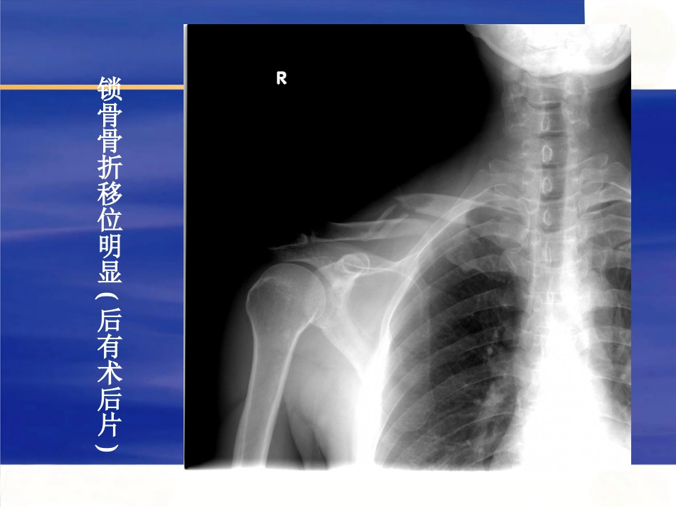 上肢骨 折_第4页