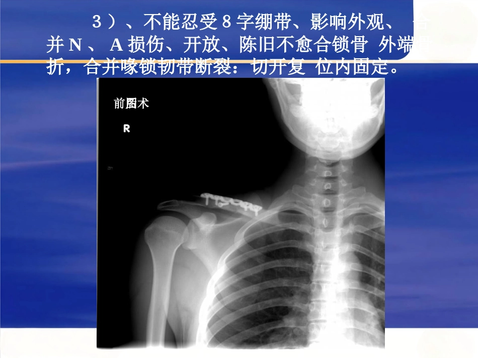 上肢骨 折_第6页