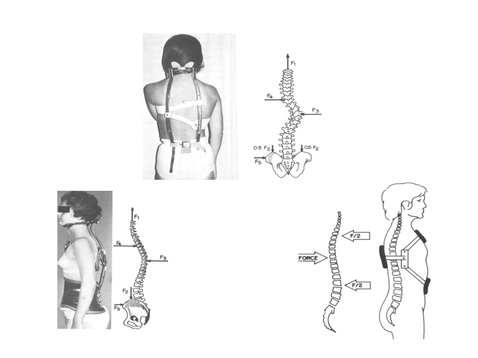 矫形器生物 力学概述_第11页