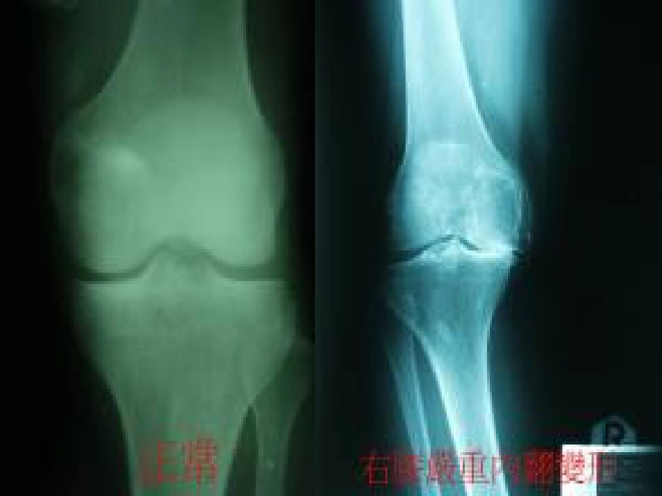 人工膝关节表面 置换术的配合_第12页