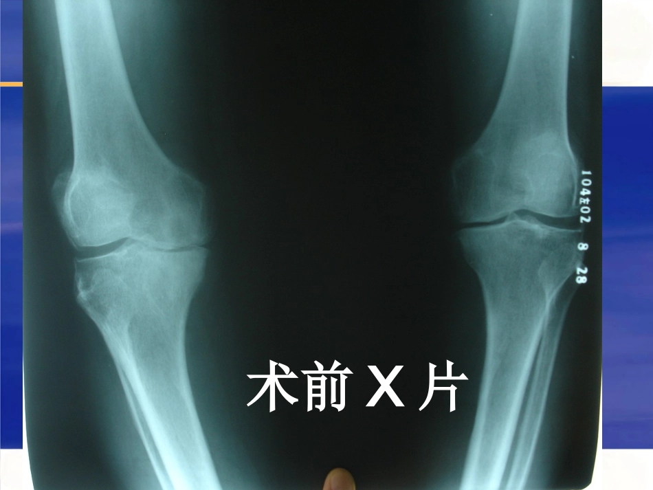 人工膝关节置换术 后疼痛原因分析_第11页