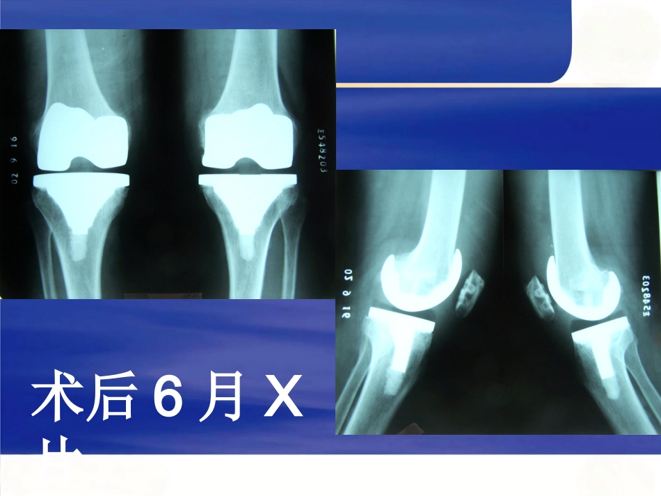 人工膝关节置换术 后疼痛原因分析_第12页