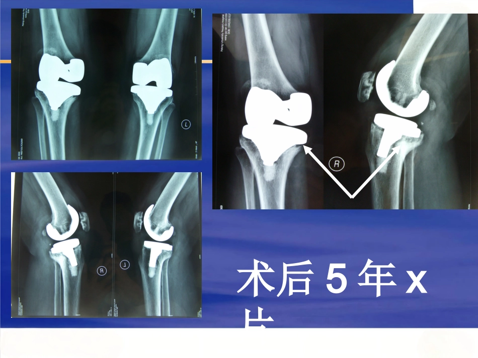 人工膝关节置换术 后疼痛原因分析_第13页