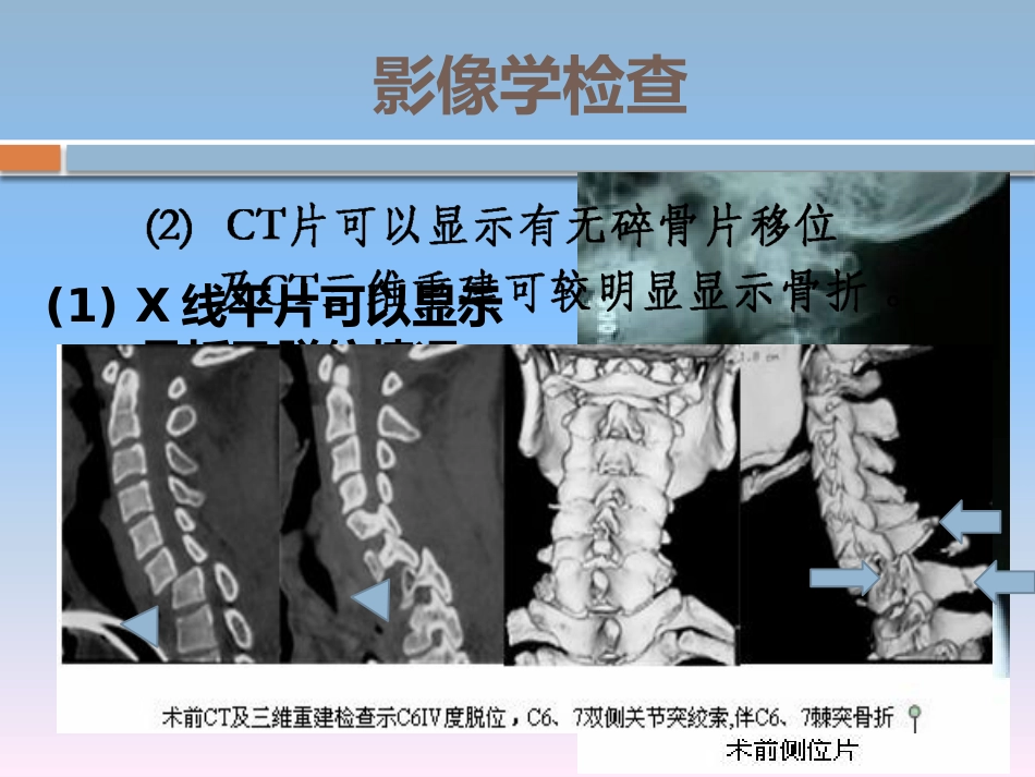 颈椎骨折的 护理_第11页