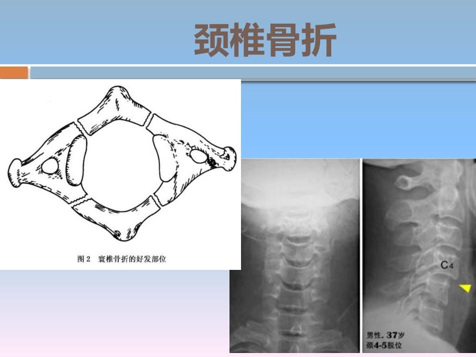 颈椎骨折的 护理_第4页