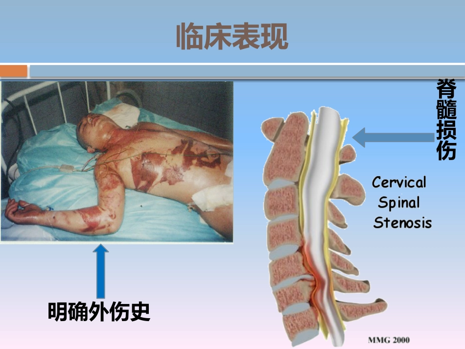 颈椎骨折的 护理_第9页