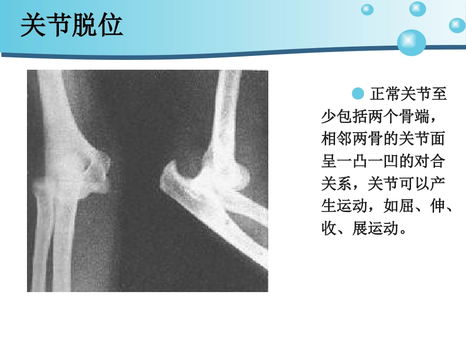 关节脱位护 理_第4页