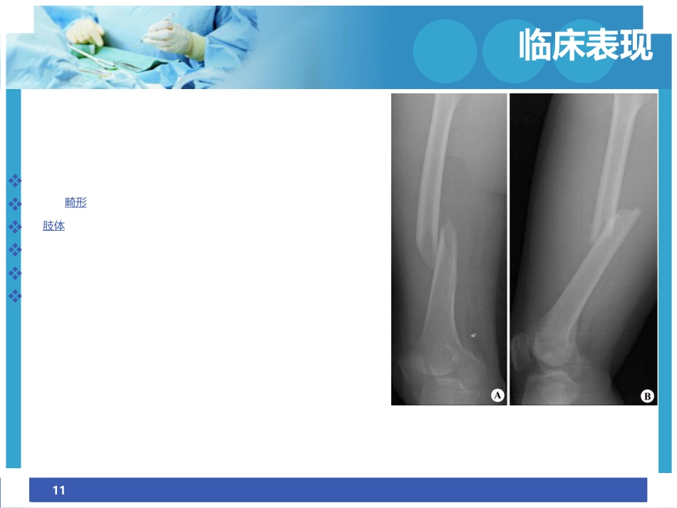 股骨干骨折护理ppt_第11页