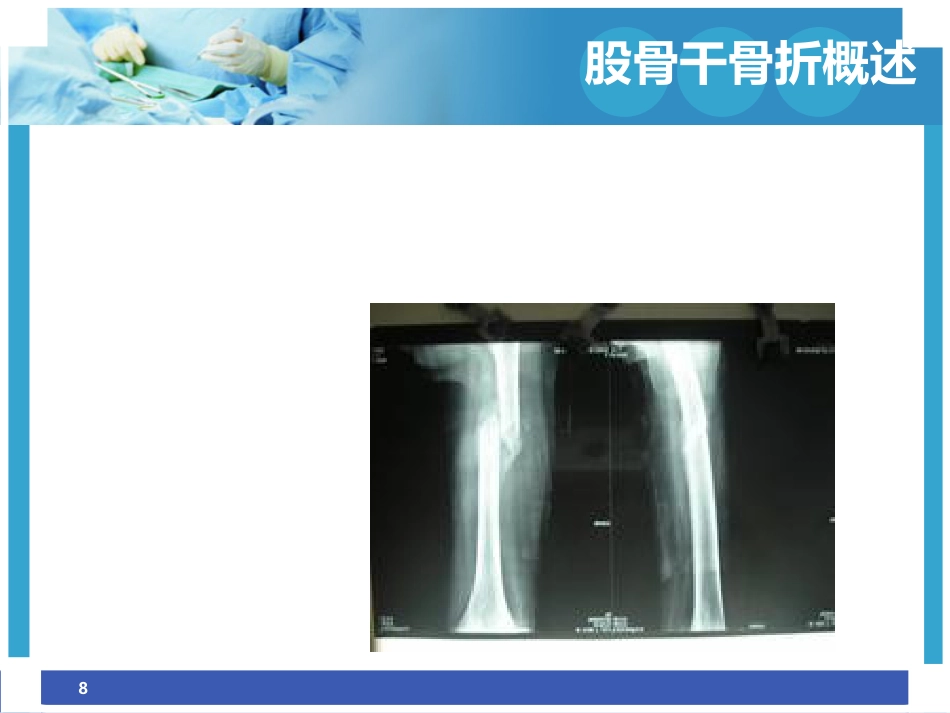 股骨干骨折护理ppt_第8页