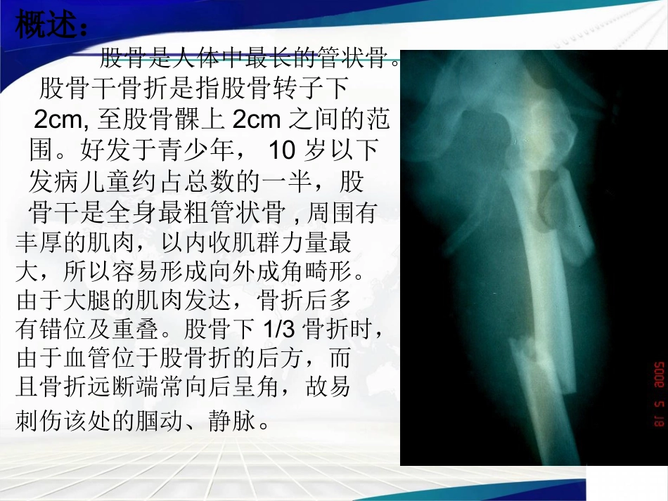 股骨干骨折 康复护理_第2页