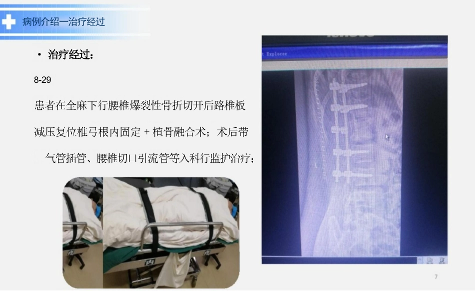脊髓损伤教学查房ppt_第7页