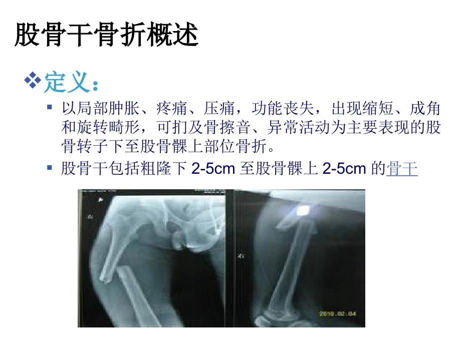 股骨干 骨折护理_第4页