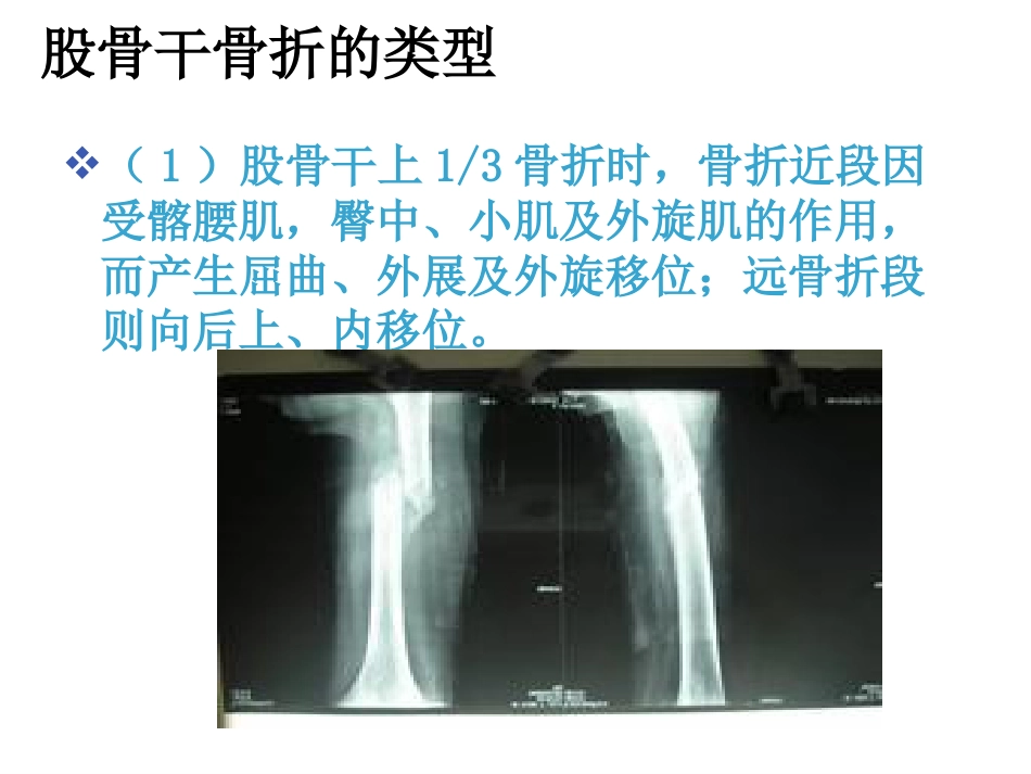 股骨干 骨折护理_第7页