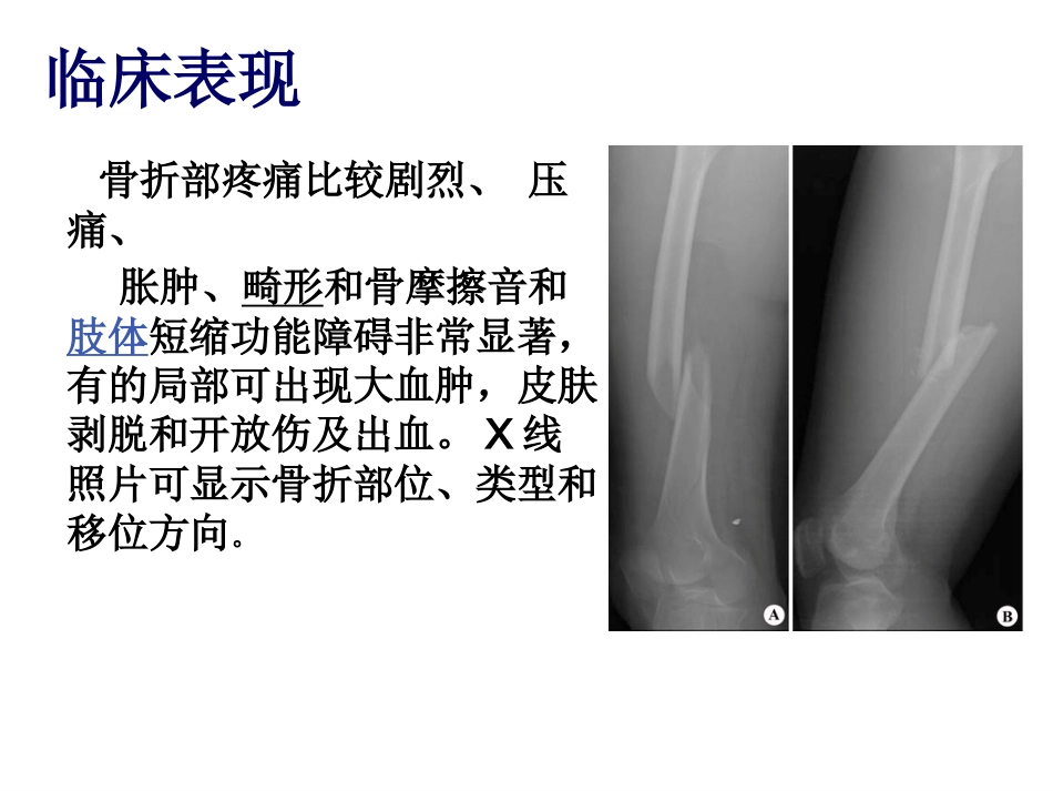 股骨干 骨折护理_第9页
