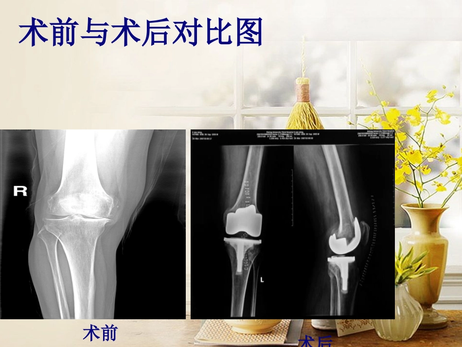 全膝关节置换术 护理及康复_第6页