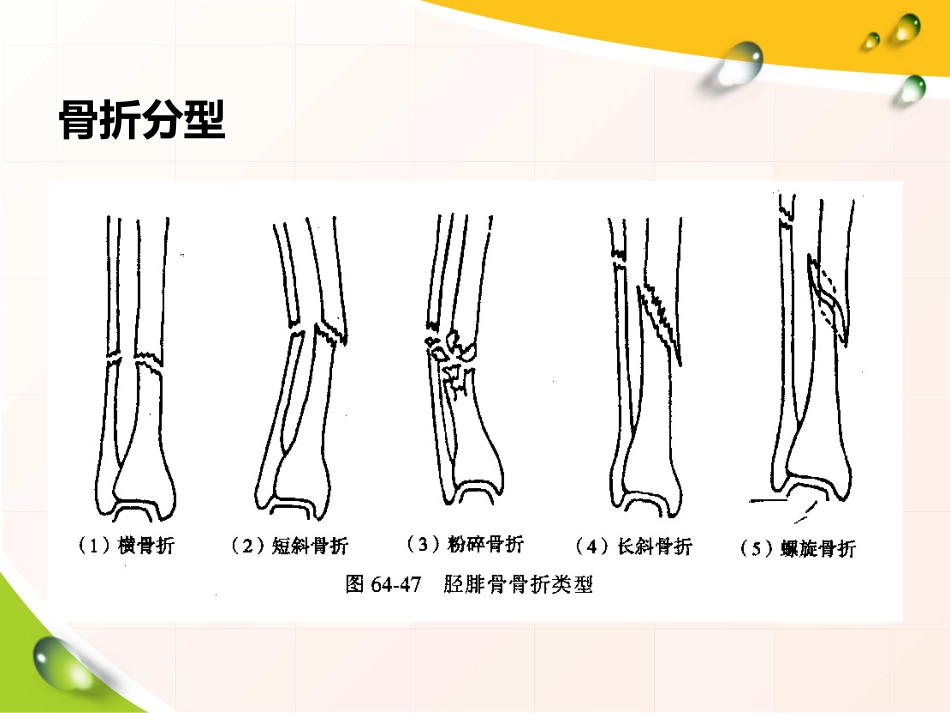 胫腓骨 骨折患者的护理_第10页