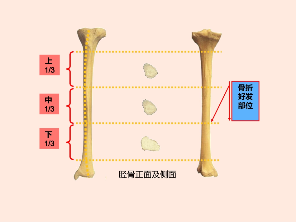 胫腓骨 骨折患者的护理_第5页