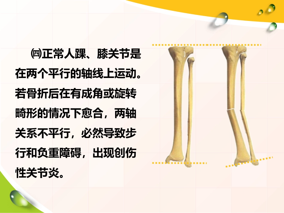 胫腓骨 骨折患者的护理_第8页
