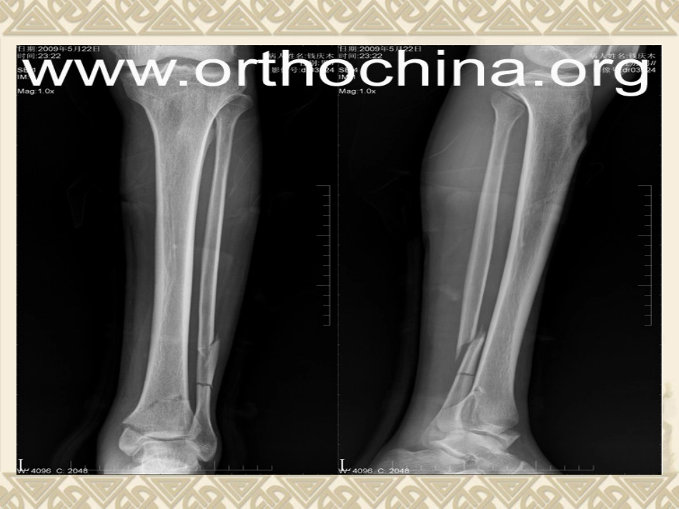 胫腓 骨骨折的护理_第12页