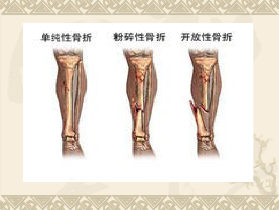 胫腓 骨骨折的护理_第5页