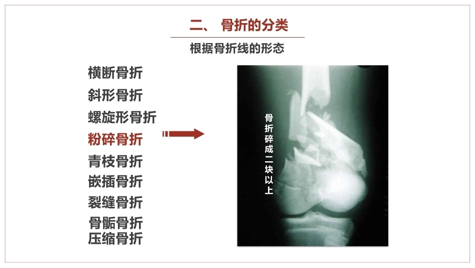 中医骨伤科学骨折概论临床知识学习课件_第10页