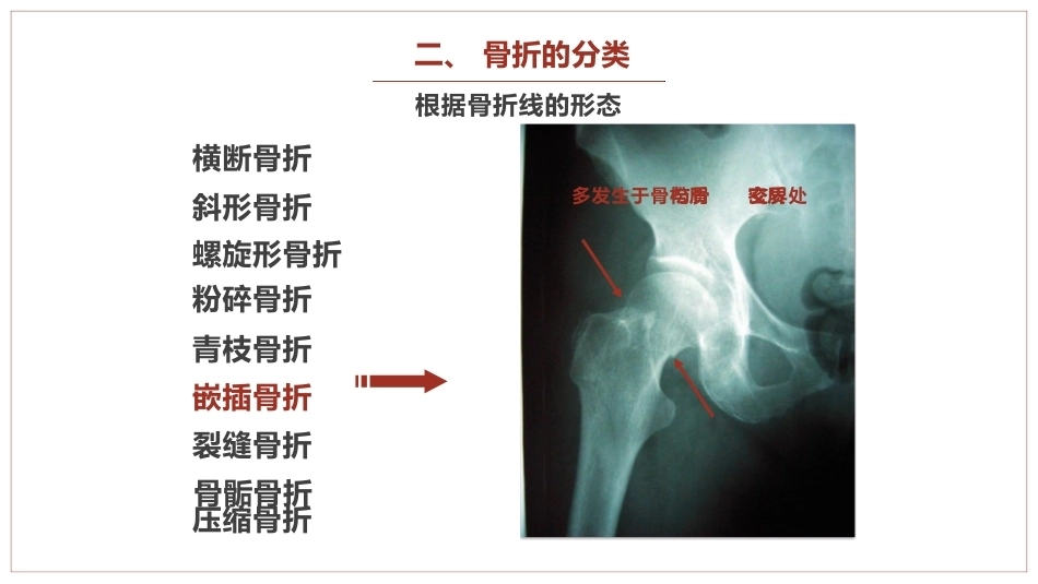 中医骨伤科学骨折概论临床知识学习课件_第12页
