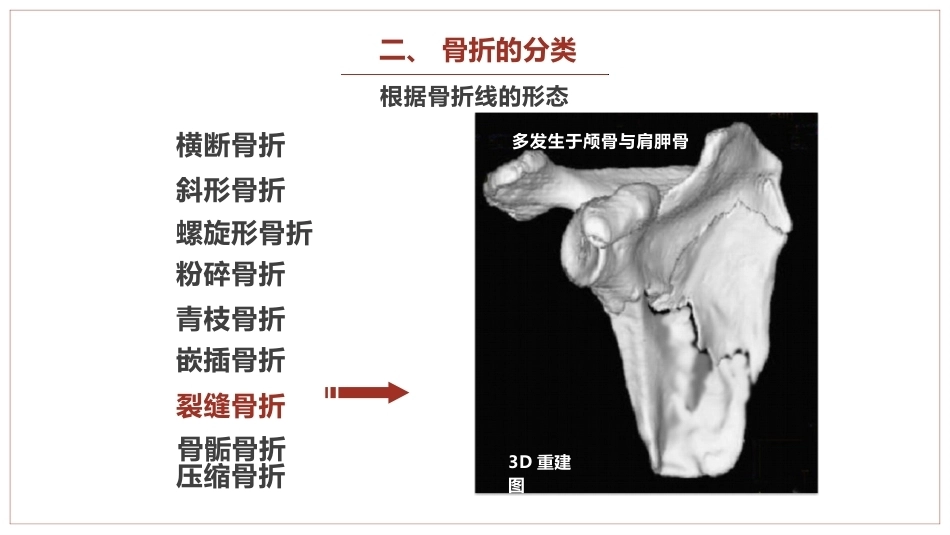 中医骨伤科学骨折概论临床知识学习课件_第13页