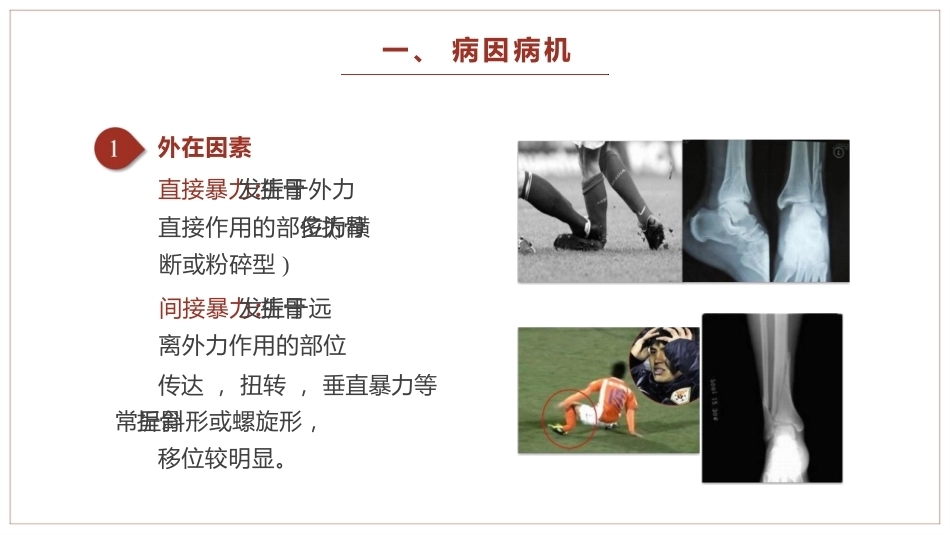 中医骨伤科学骨折概论临床知识学习课件_第3页