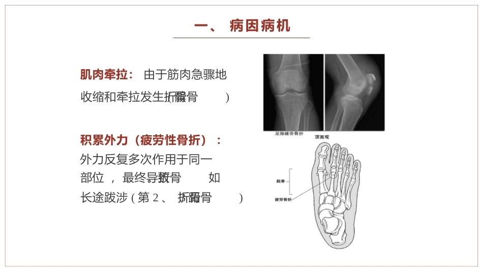 中医骨伤科学骨折概论临床知识学习课件_第4页