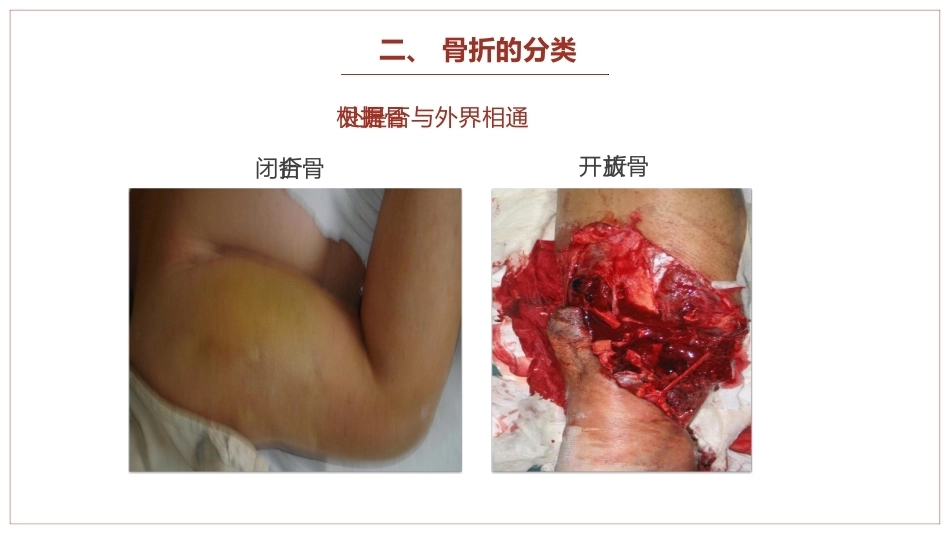 中医骨伤科学骨折概论临床知识学习课件_第6页