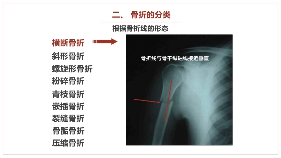 中医骨伤科学骨折概论临床知识学习课件_第7页