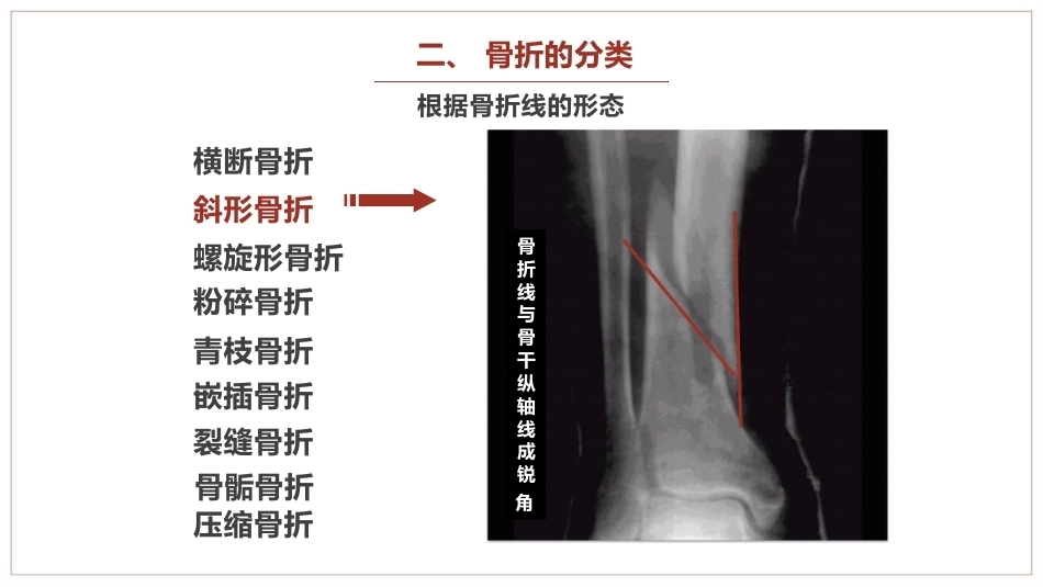 中医骨伤科学骨折概论临床知识学习课件_第8页