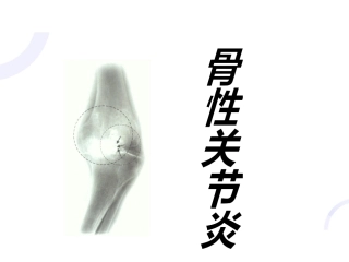 中医骨伤科学骨性关节炎部分PPT