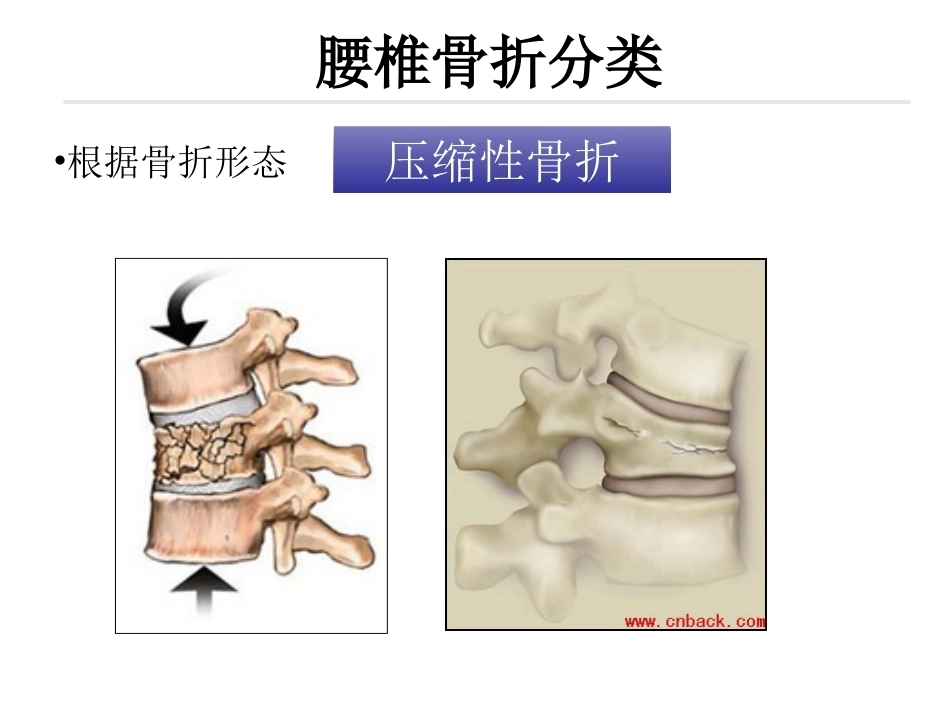 腰椎骨折 患者的护理PPT_第12页