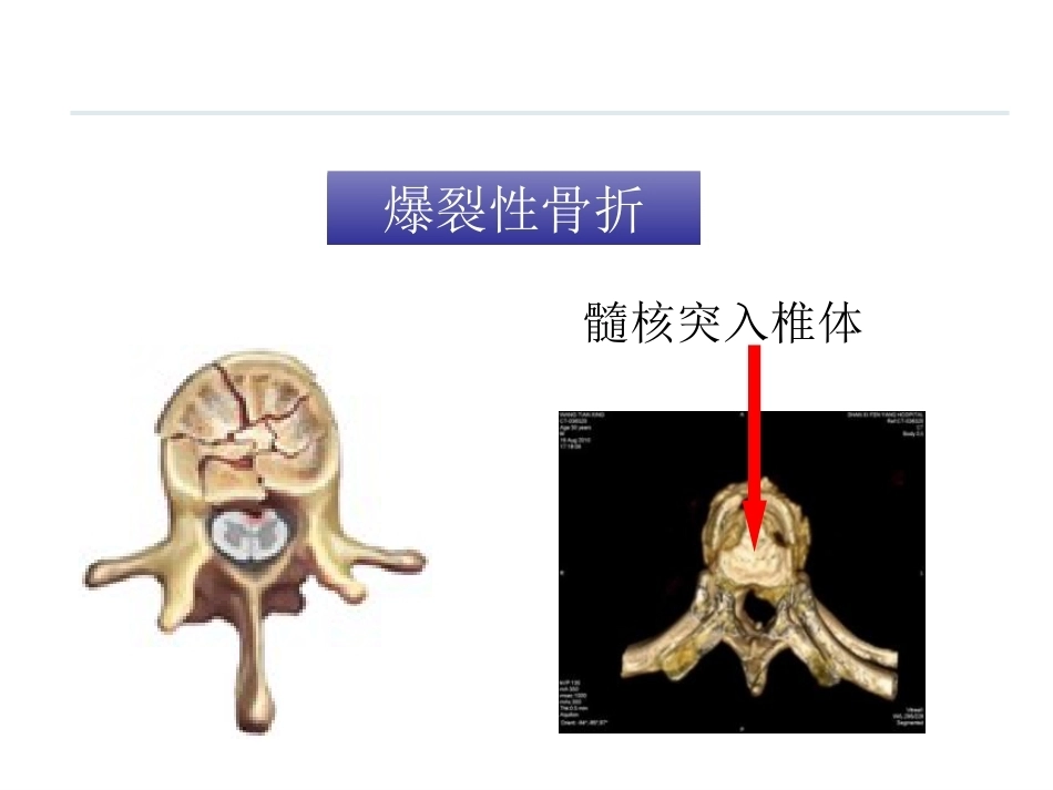 腰椎骨折 患者的护理PPT_第13页