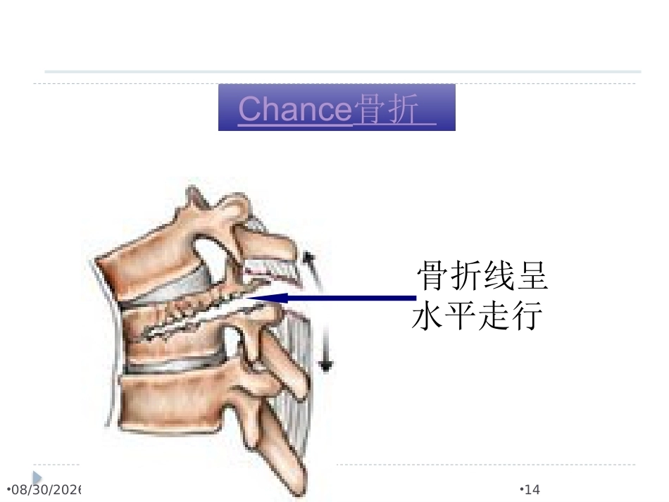 腰椎骨折 患者的护理PPT_第14页