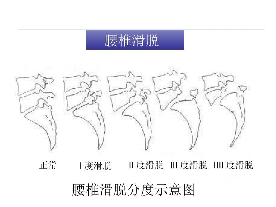 腰椎骨折 患者的护理PPT_第15页