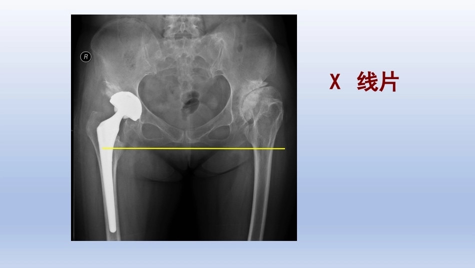 DDH 全髋关节置换手术难点及对策_第10页