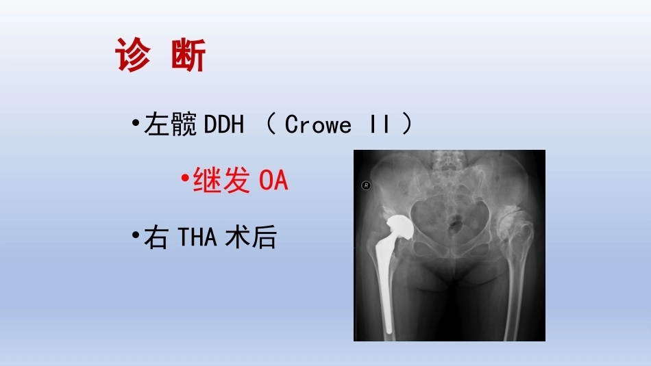 DDH 全髋关节置换手术难点及对策_第11页