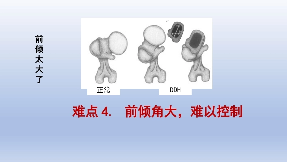 DDH 全髋关节置换手术难点及对策_第7页