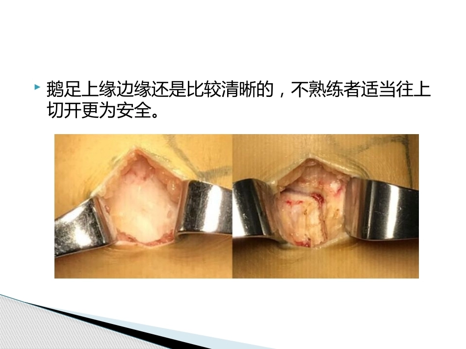如何能够快速切取腘绳肌腱_第10页