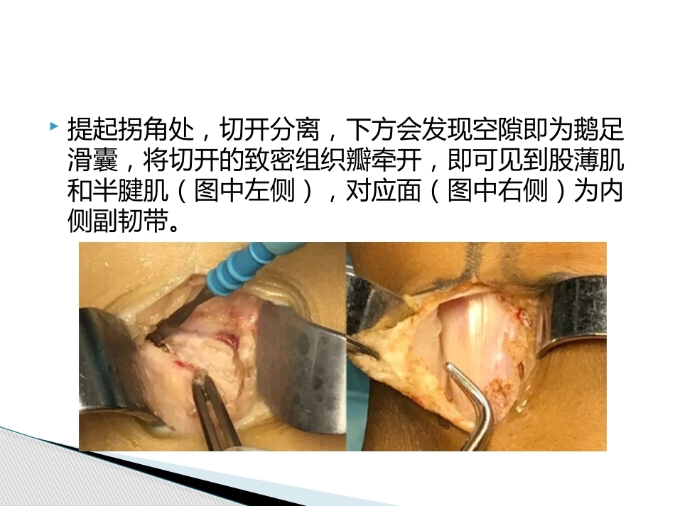 如何能够快速切取腘绳肌腱_第11页