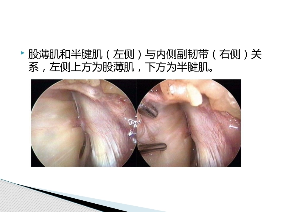 如何能够快速切取腘绳肌腱_第12页