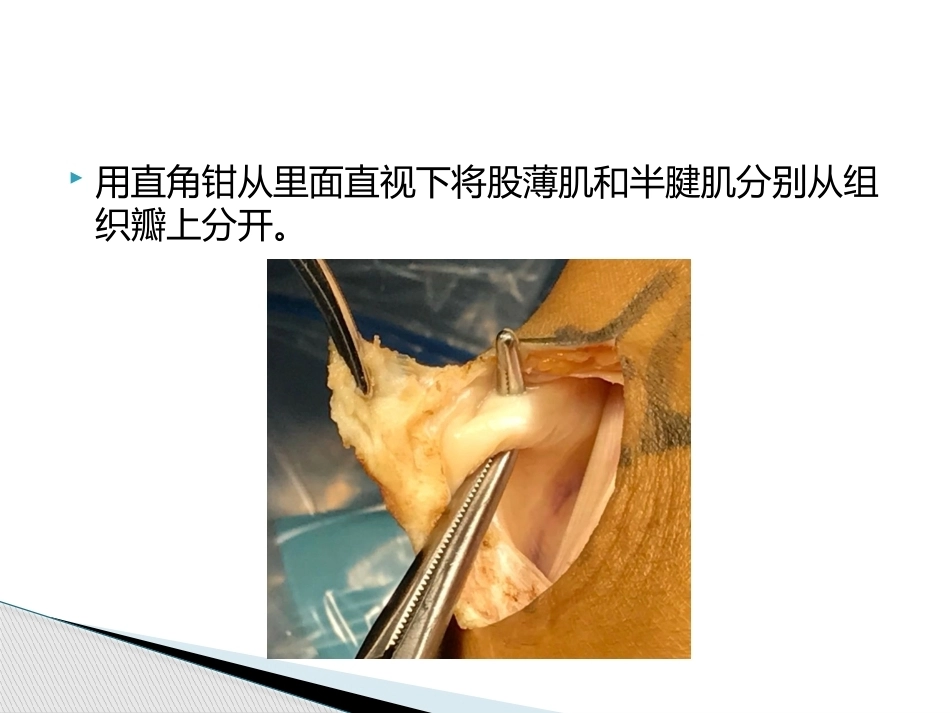 如何能够快速切取腘绳肌腱_第13页