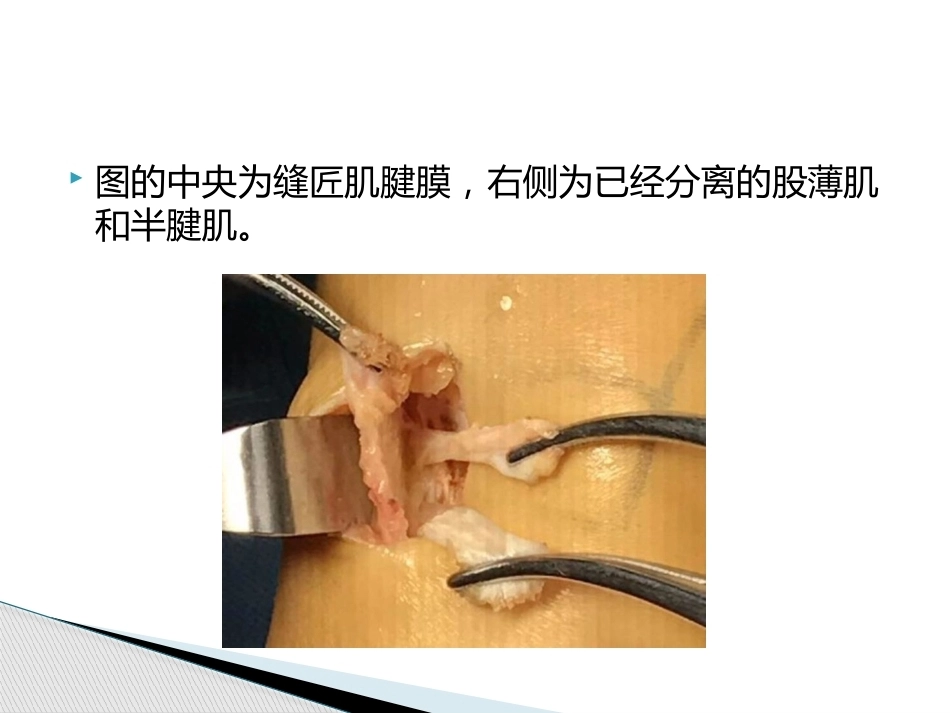 如何能够快速切取腘绳肌腱_第14页