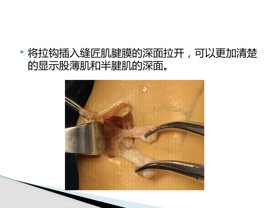 如何能够快速切取腘绳肌腱_第15页