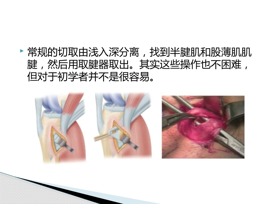 如何能够快速切取腘绳肌腱_第3页