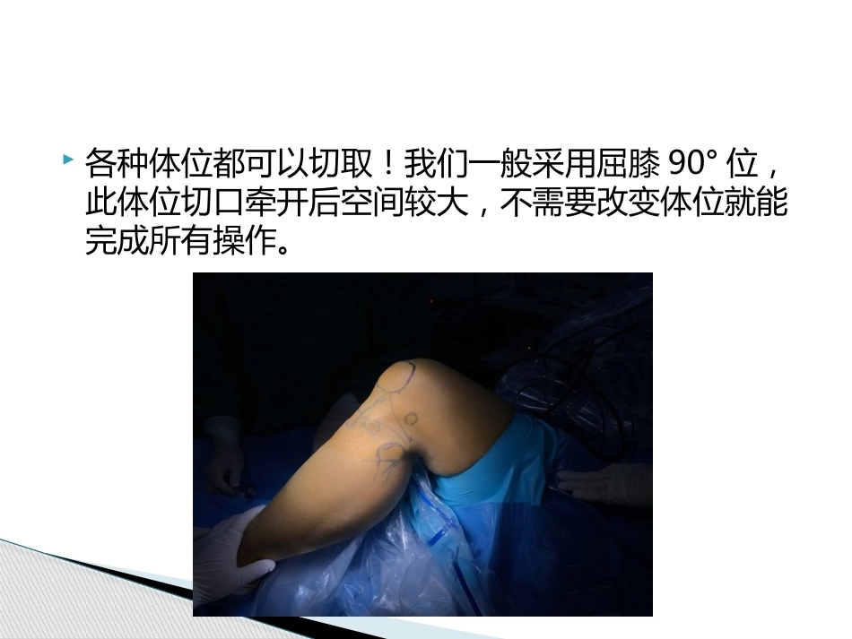如何能够快速切取腘绳肌腱_第5页
