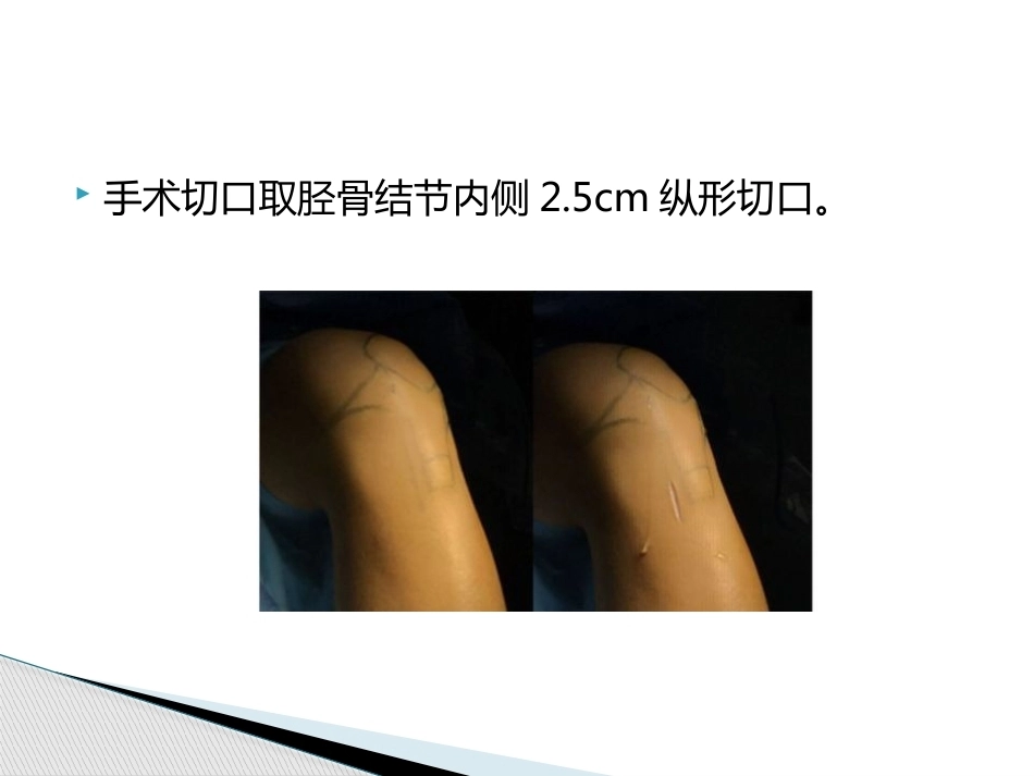 如何能够快速切取腘绳肌腱_第6页