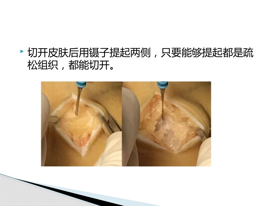如何能够快速切取腘绳肌腱_第7页
